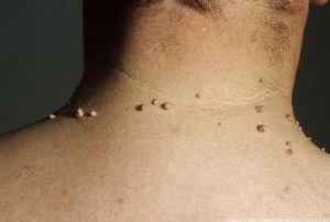 SKIN TAGS contraindications In beauty therapy