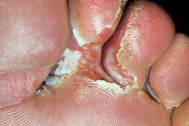 Is waxing contraindicated for athlete's foot (tinea cruris, tinea pedis)?