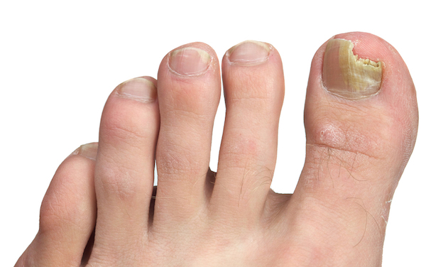 Is manicure and pedicure contraindicated for onychomycosis (tinea unguium)?