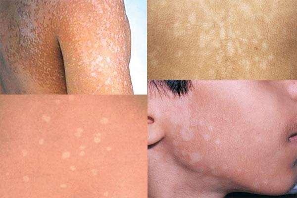 Is facial contraindicated for tinea versicolor (pityriasis
